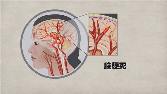 脑梗死_缺血性卒中_神经内科