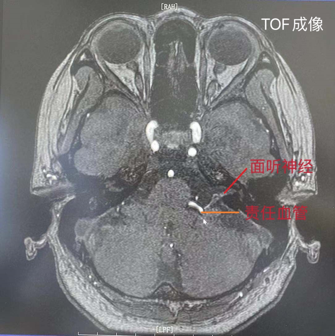 华安脑科医院成功开展首例面肌痉挛显微血管减压术